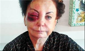 Atriz ficou de olho roxo após tropeçar em buraco n